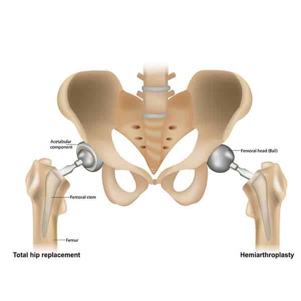 Hip replacement