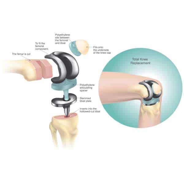 Knee replacement