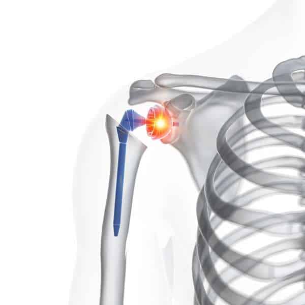 shoulder replacement